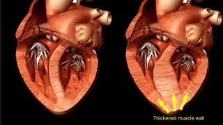 Hypertrophic Cardiomyopathy [upl. by Anabahs516]