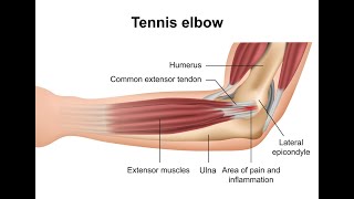 Tennis Elbow Cant Wait [upl. by Gunas]