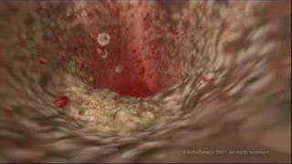 MEDICAL  How cholesterol clogs your arteries atherosclerosis [upl. by Kahl977]