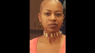 My Hair Journey with Scarring Alopecia [upl. by Clevie]