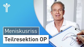 Meniskus OP Meniskusriss arthroskopisch behandeln  Teilresektion [upl. by Pacificia]