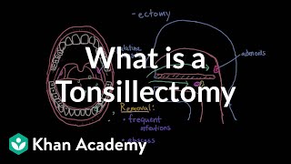 What is a tonsillectomy  Respiratory system diseases  NCLEXRN  Khan Academy [upl. by Livy]