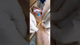 HOW TO INSERT IV INTRAVENOUSPEREPHERAL CANNULA [upl. by Lenna956]