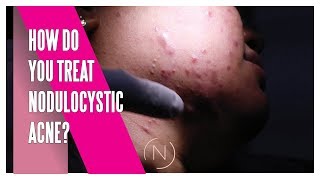 How Do You Treat Nodulocystic Acne  Houston Dermatology [upl. by Leksehc]