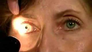 Cranial Nerves II amp III  Pupillary Light Reflex 525 [upl. by Armallas]