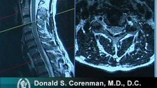 What is Cervical Stenosis  Jeffrey Cantor MD [upl. by Ahsiekan971]