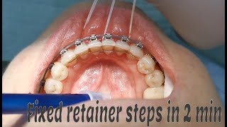 Fixed orthodontic retainer steps [upl. by Manville]