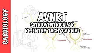 What is Ventricular Tachycardia VT [upl. by Ilecara942]