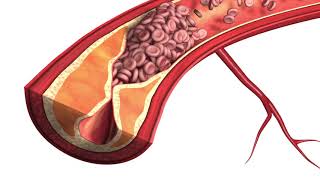 Atherosclerosis  Plaque Animation Model [upl. by Ayetal]