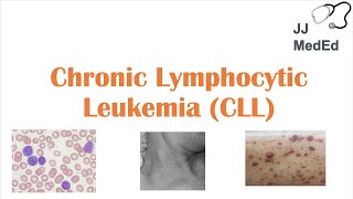 NonHodgkin Lymphoma  What you need to know [upl. by Koerner]