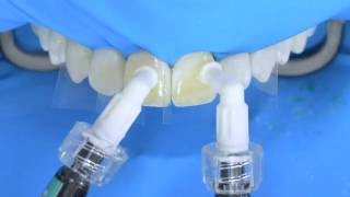 Fluorosis treatment using Icon infiltration step by step [upl. by Goto]