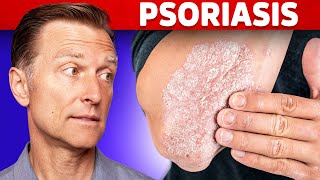 Psoriasis  9 Natural Treatments for Psoriasis  Dr J9 Live [upl. by Rennug]