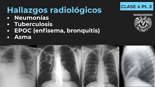 043  Neumonía TB EPOC Enfisema Bronquitis Bronquiectasias Asma [upl. by Annaiv487]