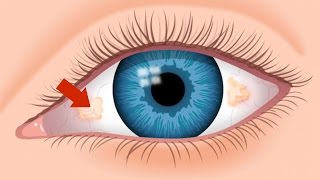 What Are The Ugly Yellow Spots In My Eye  An Optometrist Explains  True Eye Experts [upl. by Lehctim464]