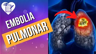 EMBOLIA PULMONAR – Causas Sintomas e Tratamento [upl. by Eednam665]