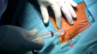 Pacemaker Implantation [upl. by Leake]