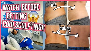 SHOCKING Coolsculpting Before amp After 6 Things You NEED to Know [upl. by Teodoro]