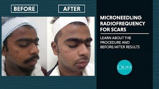 Microneedling RadiofrequencyRF Treatment Before And After Results  Oliva Clinic [upl. by Melosa]