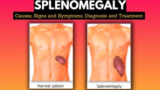 Splenomegaly Causes Signs and Symptoms Diagnosis and Treatment [upl. by Llennoc]