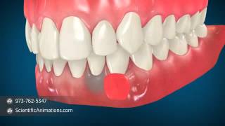 Gum Grafting Surgery  Dental Animation [upl. by Rida]