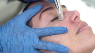 Awaken Eyes  MDPen MicroNeedling [upl. by Anawqahs401]