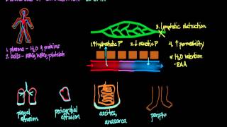 Disorders of Circulation Edema [upl. by Zipporah]