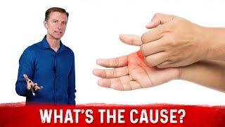 What Causes Sweaty  Dry Hands amp How To Get Rid Of It – Dr Berg [upl. by Sternlight]