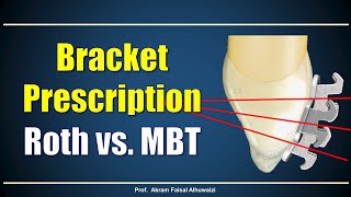 Using Roth and MBT brackets [upl. by Fahland]