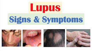 Lupus Signs amp Symptoms amp Why They Occur  Skin Joints Organ Systems [upl. by Bald878]