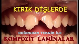 Kırık Ön Dişlerde Kompozit Laminalar 2 [upl. by Adnema]