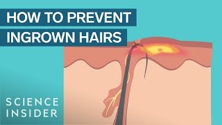 What Are Ingrown Hairs — And How To Treat Them [upl. by Grossman864]