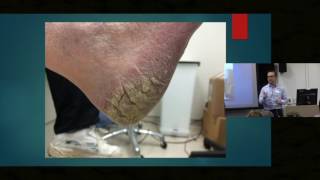 Itch in Elderly Skin  Dr Ian Bekker [upl. by Aubert]