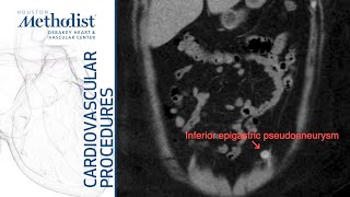 Abdominal Pain Causes Signs and Symptoms Diagnosis and Treatment [upl. by Ikey]