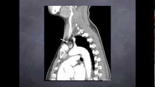 Parathyroid CT Scanning [upl. by Yazbak]