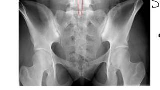 Sacrum Coccyx and SI Joints [upl. by Lamar18]