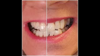 Crest Whitestrips 1Hour Express  Two Uses  Honest Review  KimTownselYouTube [upl. by Ecaroh296]