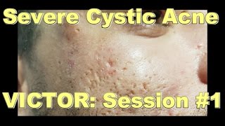 Severe Cystic Acne  Victor Session 1 [upl. by Elburr]