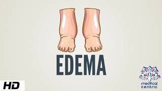 Edema Causes Signs and Symptoms Diagnosis and Treatment [upl. by Lough]