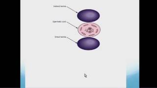 NEUROFIBROMA AND SCHWANNOMA Clinical features amp Morphology [upl. by Dazraf]