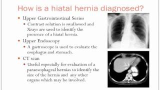 Hiatal Hernias [upl. by Denver]