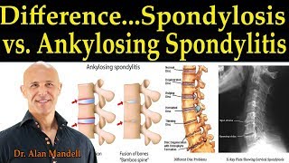 What are the symptoms of cervical spondylosis  Dr Umesh Srikantha  Aster CMI Hospital Bangalore [upl. by Itoyj]