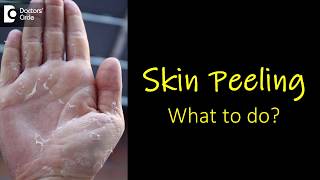 What causes skin peeling from fingers and feet How to manage  Dr Rasya Dixit [upl. by Hurff712]