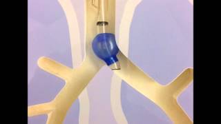 Double lumen endotracheal tubes [upl. by Codie]