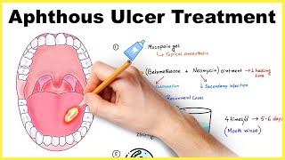 Aphthous ulcerstomatitis Vs Traumatic ulcer [upl. by Euseibbob]