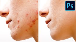 5 Ways to Remove Pimples FAST [upl. by Ailadgim185]