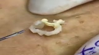 Cyst and blackheads extraction 267  Loan Nguyen [upl. by Stokes626]