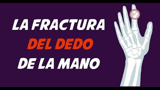 FRACTURA DE DEDOS  Causas signos y síntomas diagnóstico y tratamiento [upl. by Clere761]