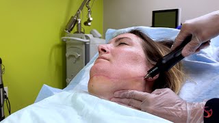 Vaser Liposuction for the Chin [upl. by Kemme]