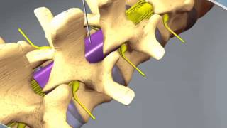 What to expect during an Epidural Steroid Injection at RAYUS [upl. by Halas777]