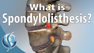 What Is Spondylolisthesis [upl. by Kassity]